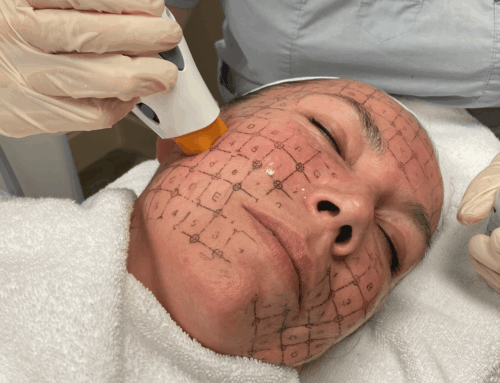 The Best Ways to Treat Fine Lines and Wrinkles