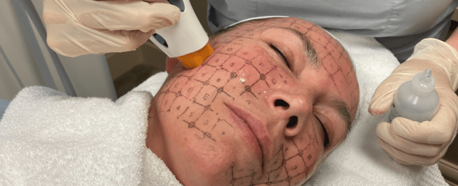 Woman with grid on face getting Thermage treatment.