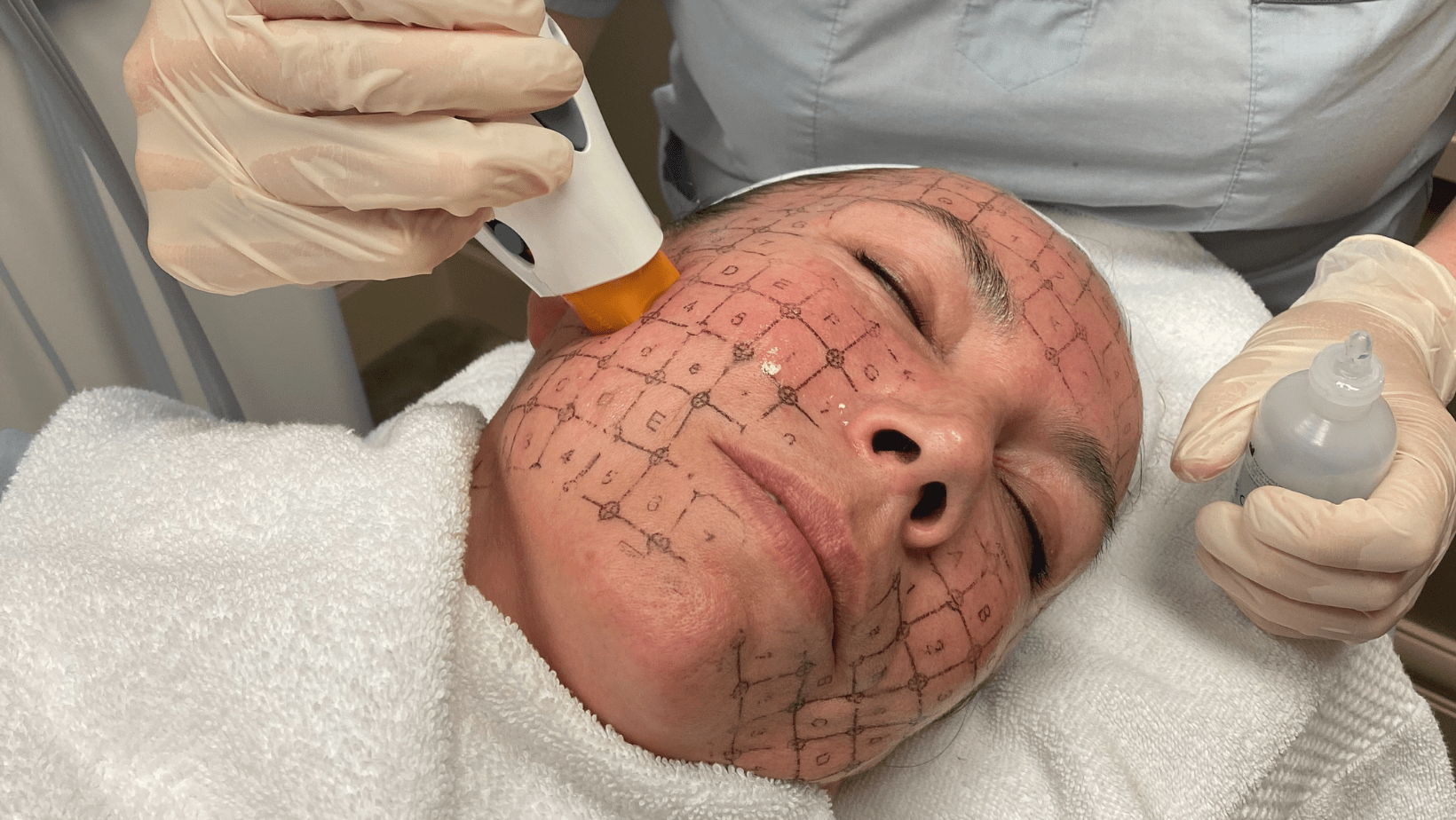 Woman with grid on face getting Thermage treatment.