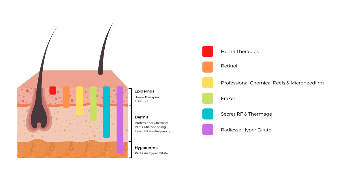 Layers of the Skin with Treatment Depths