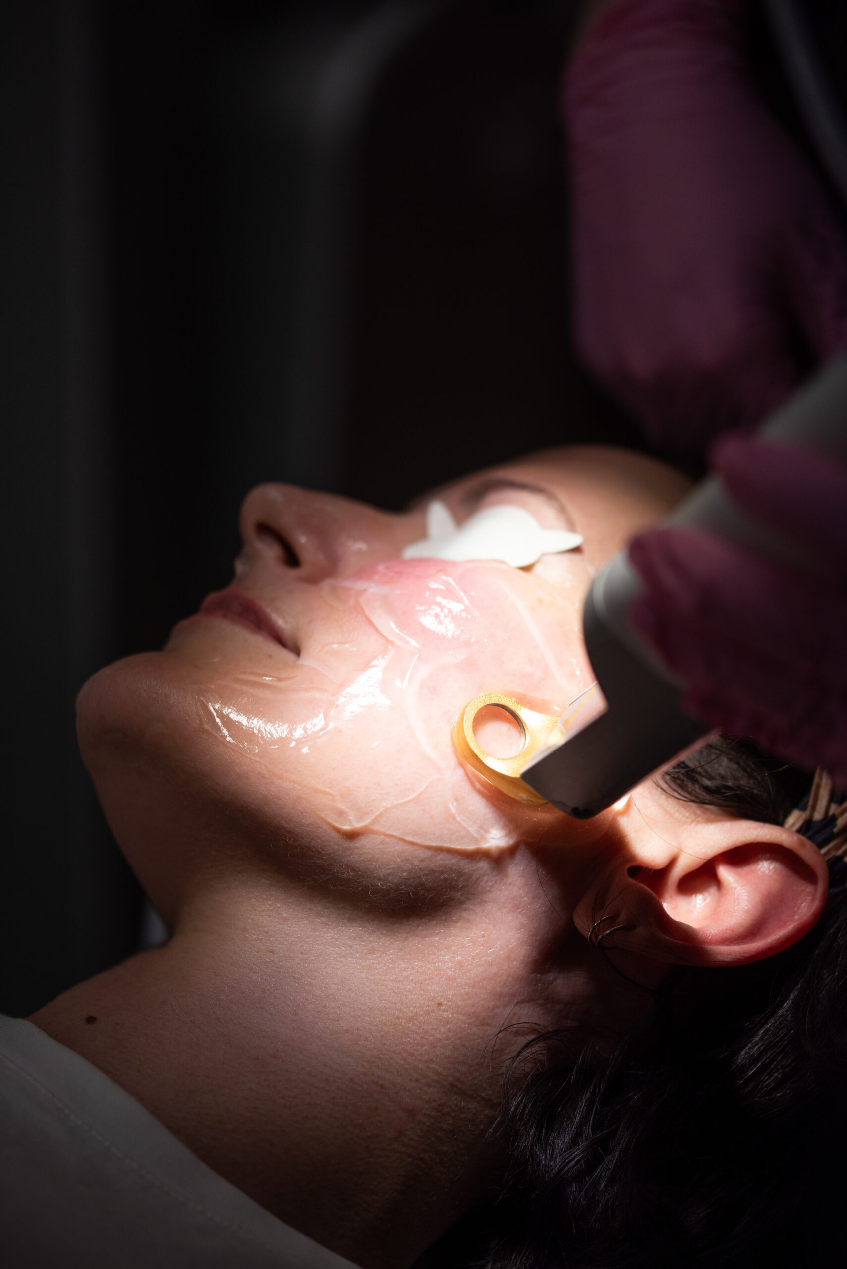 Woman getting an Excel V Treatment at Kamloops Skin Solutions