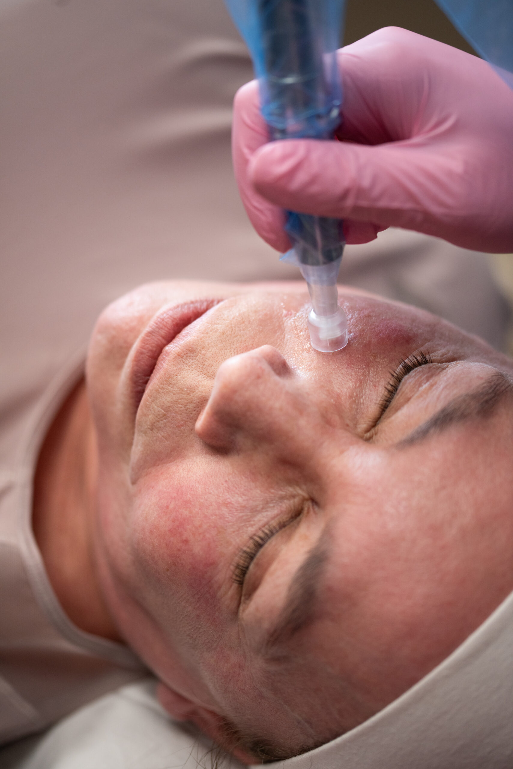 Woman getting a Microneedle Treatment at Kamloops Skin Solutions