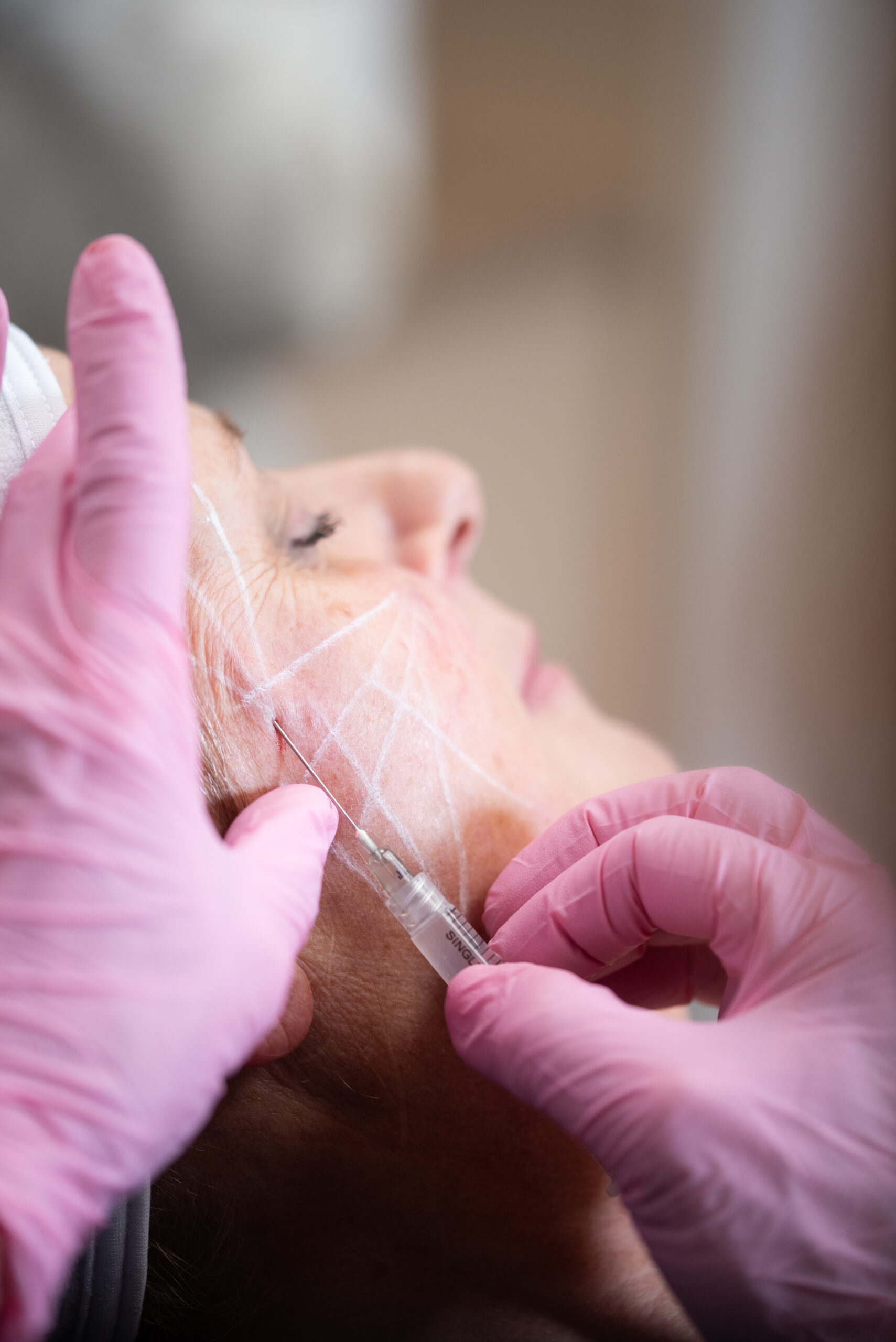 Woman getting a Sculptra Treatment at Kamloops Skin Solutions