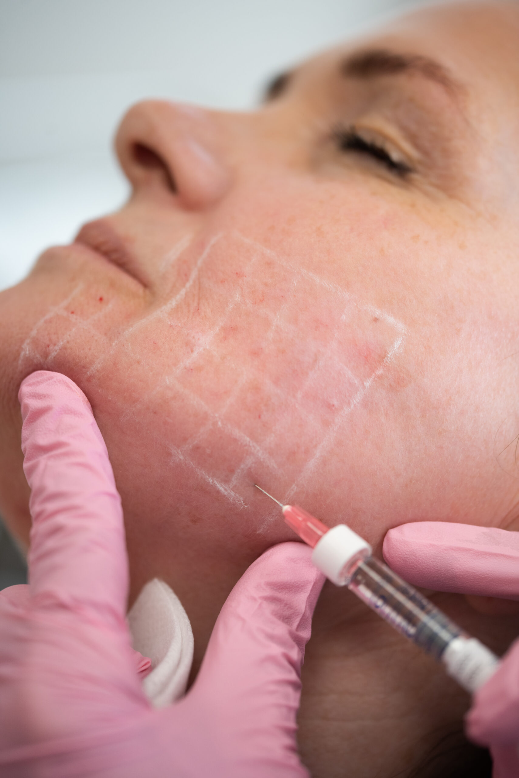 Woman getting a Skinboosters Treatment at Kamloops Skin Solutions