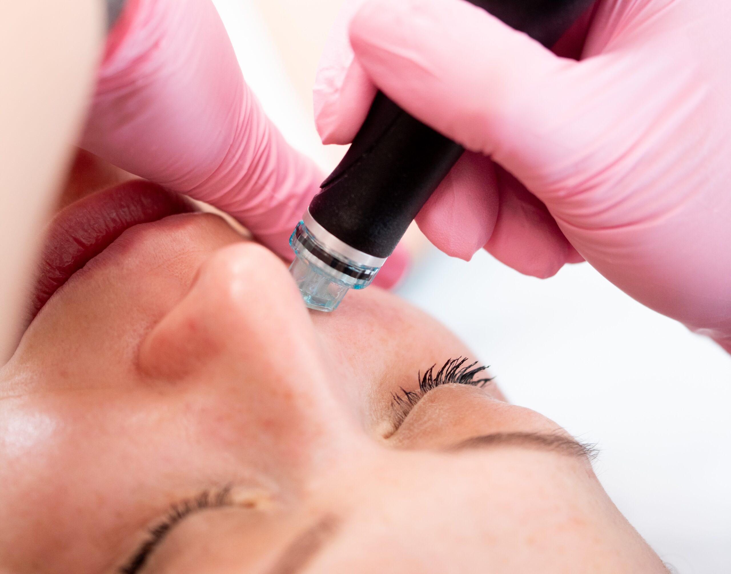 Woman getting a Hydrafacial Treatment at Kamloops Skin Solutions
