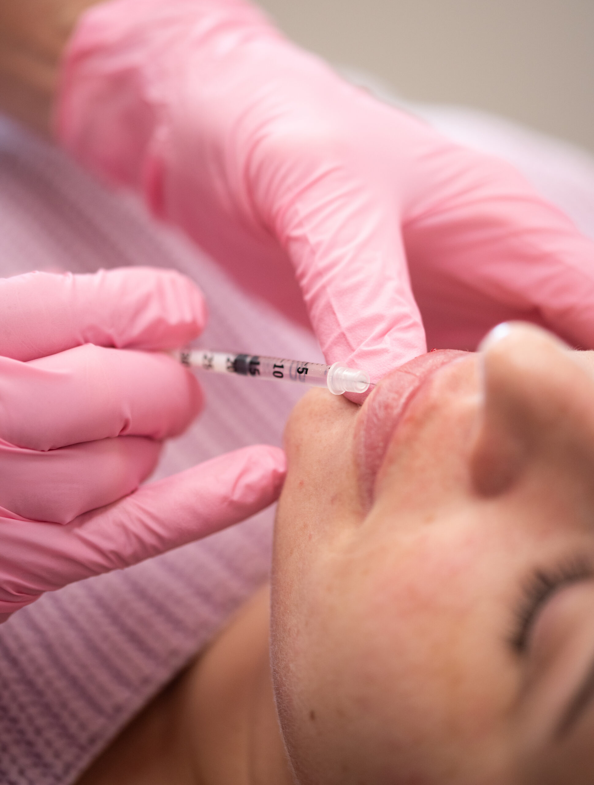 Lip filler injection being performed by an aesthetic practitioner at Kamloops Skin Solutions.